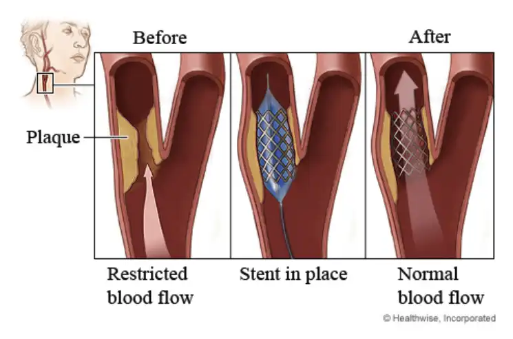 before and after a stent