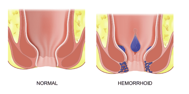 hemorrhoid diagram example