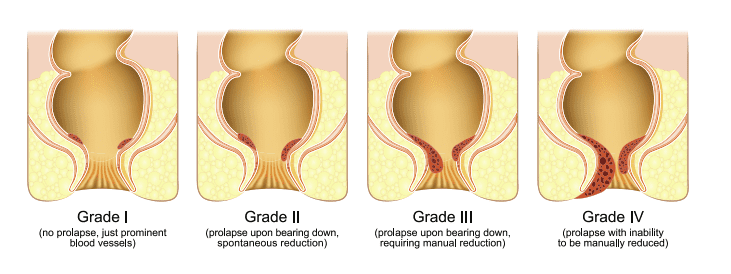 hemorrhoid grades diagram