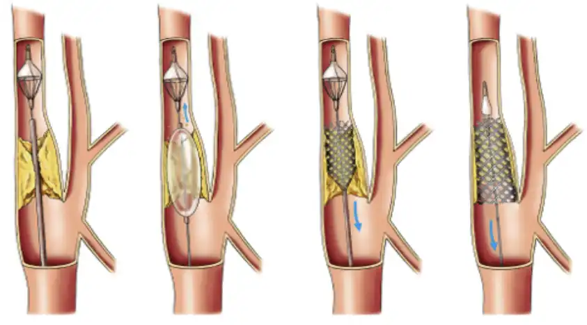stent procedure step by step diagram